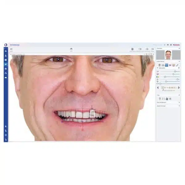 Romexis Smile Design